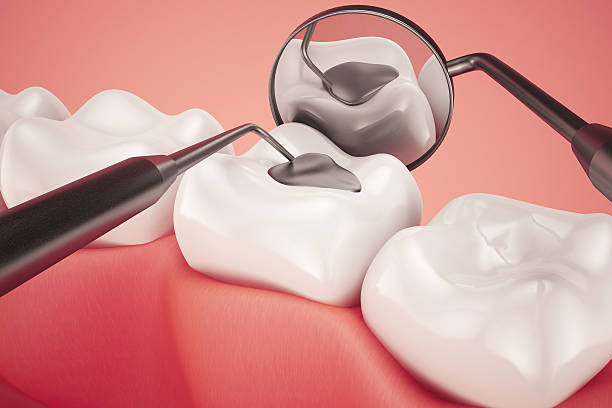 Dental filling restoration procedure at Magna Dental Clinic