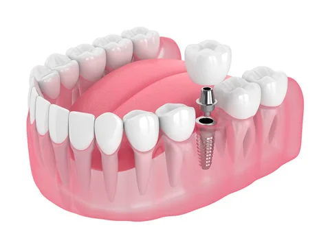 Dental implants at Magna Dental Clinic