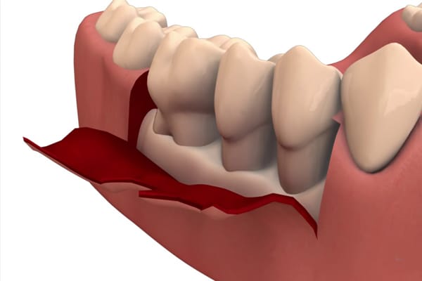Periodontal flap surgery treatment at Magna Dental Clinic