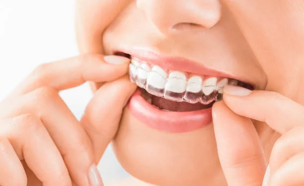 Invisible aligners at Magna Dental Clinic