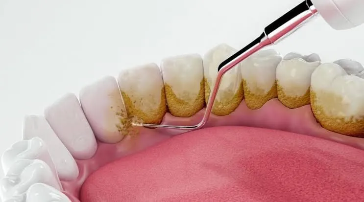 Professional scaling and teeth cleaning at Magna Dental Clinic