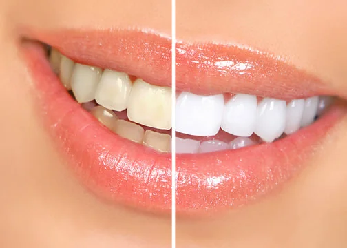 Teeth whitening treatment at Magna Dental Clinic